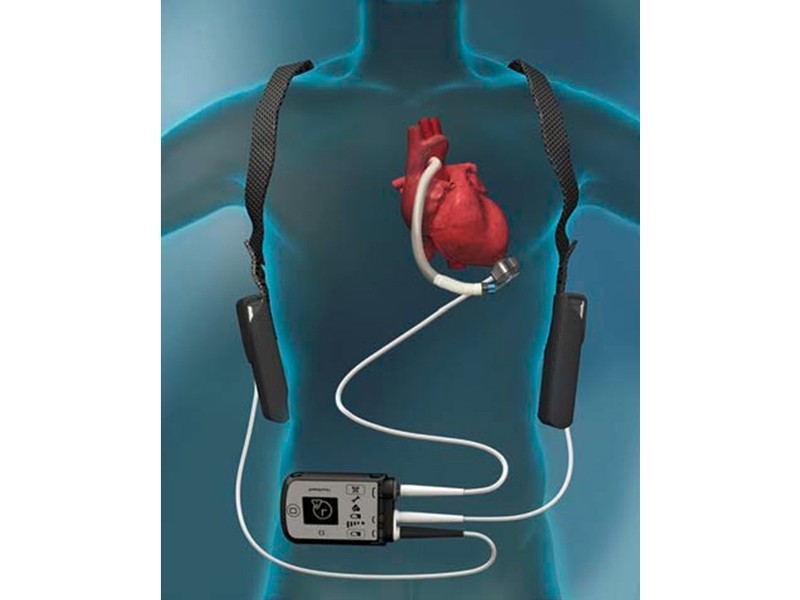 Heartfelt Innovation: India’s Cost-Effective LVAD Breakthrough!