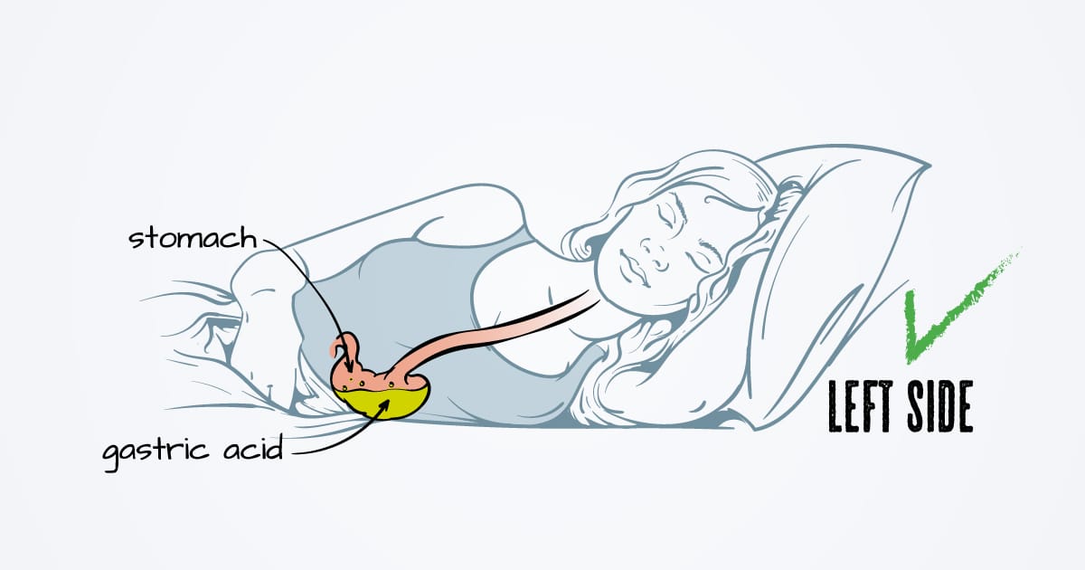 Doctors Recommend Specific Left-Side Sleeping Position for Acid Reflux