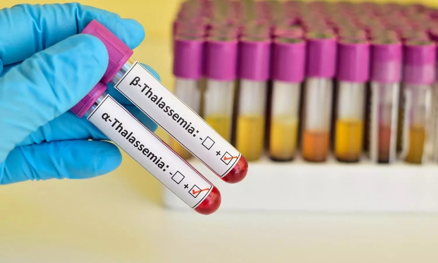 Towards a Healthier Future: How Screening and Education Can Help Eliminate Thalassemia in India