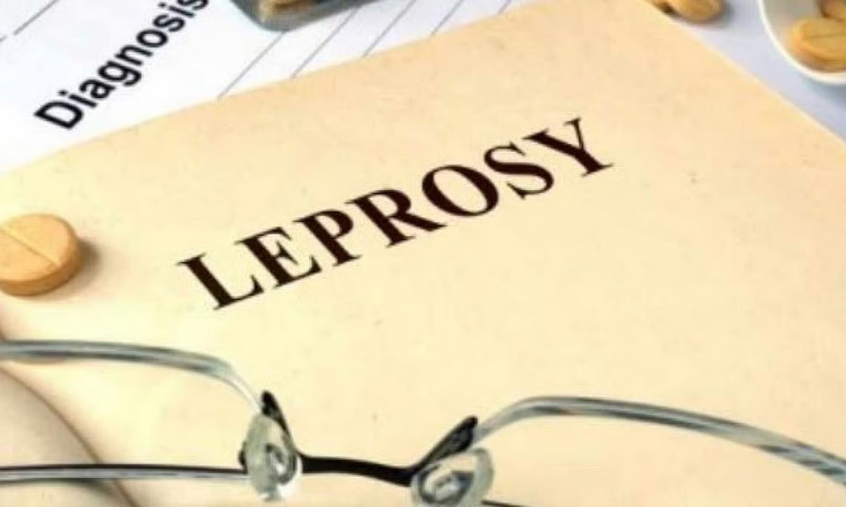 Government To Notify Leprosy Under Epidemic Act For Stronger Response
