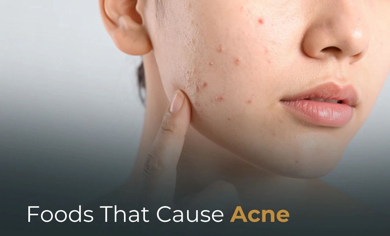 Dermatologists Warn Biscuits And White Bread Can Trigger Acne