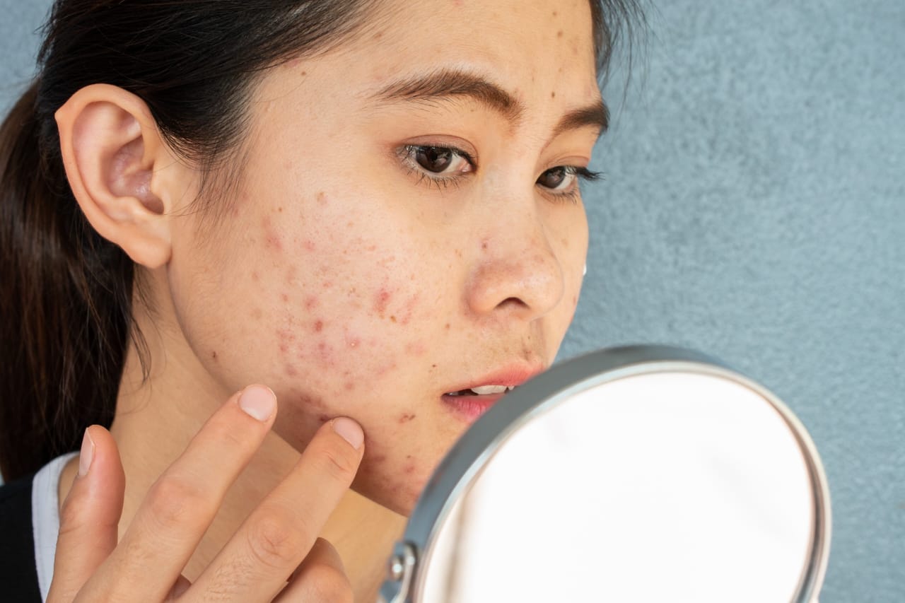 Hormonal Acne Exposé: The Unexpected Face of Adult Skin Struggles
