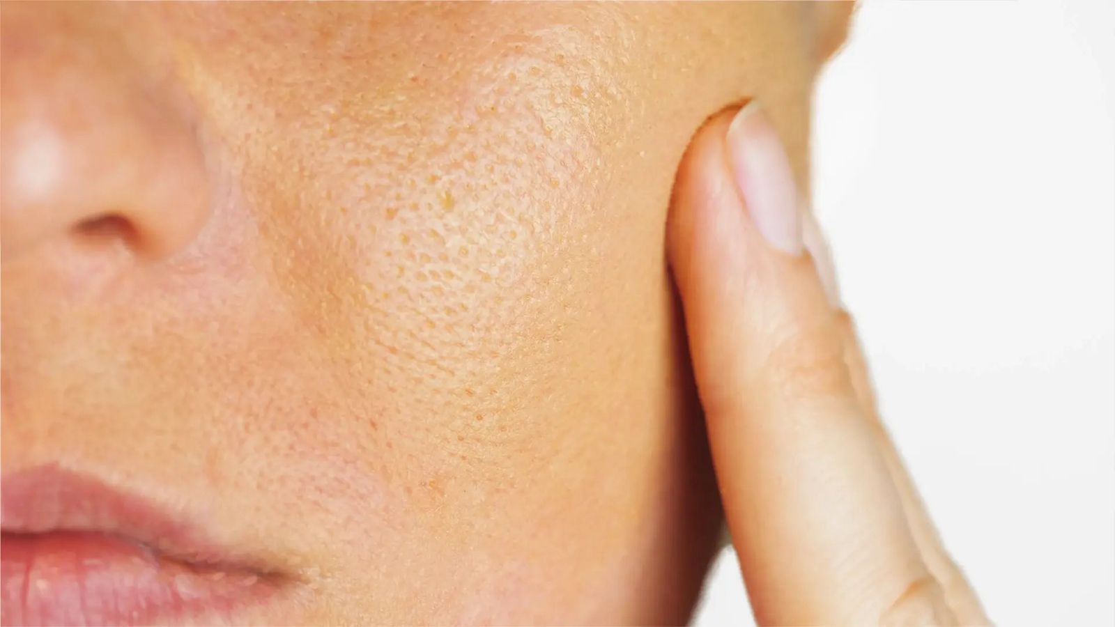Open Pores on Face: 5 Effective Home Remedies You Can Try