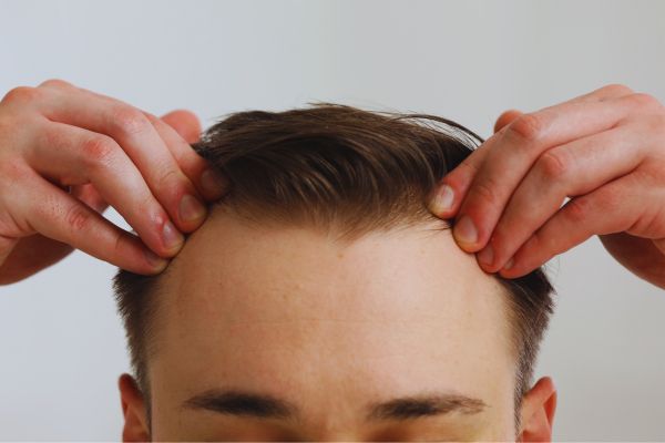 Dermatologists Recommend 7 Natural Remedies to Slow Receding Hairlines